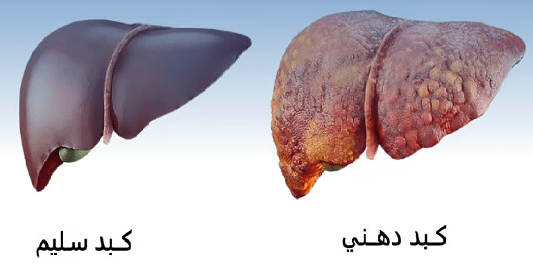 “أوزمبيك”-يعكس-أمراض-الكبد-الخطيرة:-نتائج-سريرية-مبشّرة-بسيماجلوتيد-تغيّر-قواعد-العلاج
