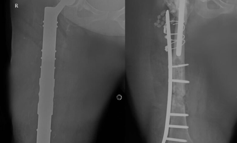 مستشفى-الدكتور-سليمان-الحبيب-بالخبر-يستبدل-مفصلي-الركبة-والورك-وعظمة-الفخذ-ويزيل-ورما-وزنه-“20”-كجم-ويعيد-“الحركة”-لـ”ستينية”