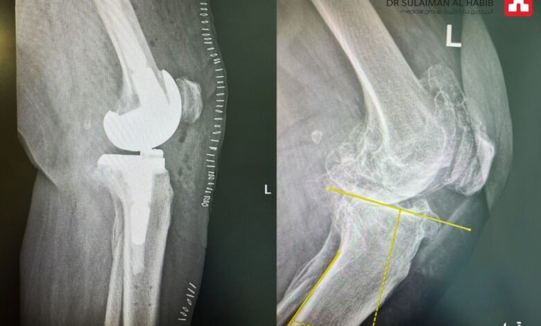 مستشفى-الدكتور-سليمان-الحبيب-بالخبر-يُجري-عملية-زراعة-مفصل-معقدة-بتقنية-“الروبوت-الجراحي”-لإعادة-قدرة-المشي-لثمانينية